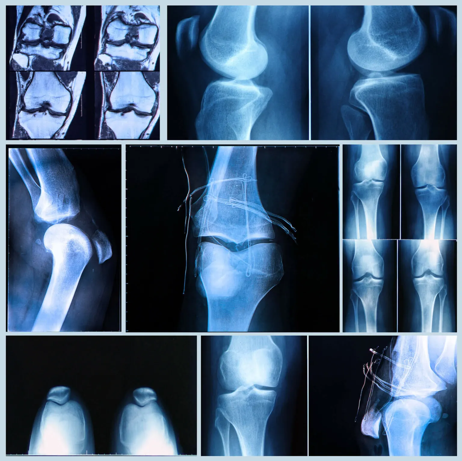 stem cells therapy in Franklin used for various bone injuries X-ray images